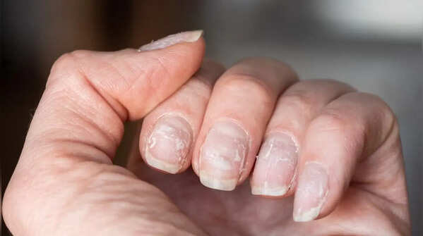 Brittle nails, dry skin, thin hair