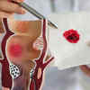 Rectal bleeding