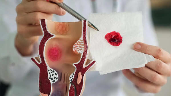 Rectal bleeding
