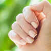 Hair loss and brittle nails