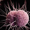 Gonorrhea: What is it?