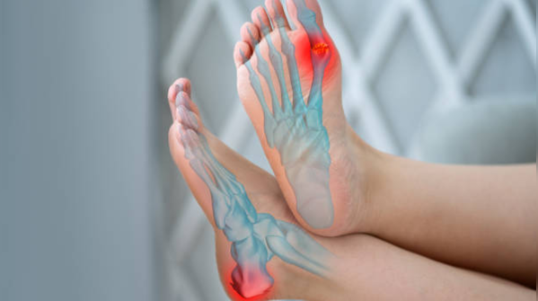 Bunions