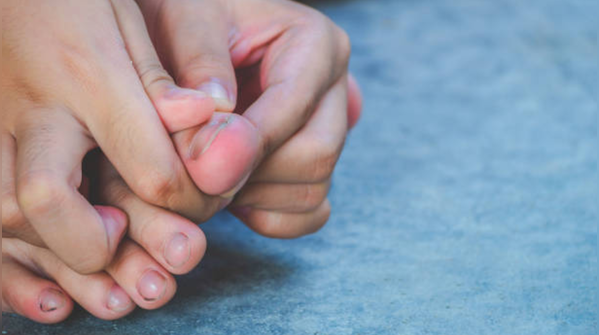 Plantar Fasciitis
