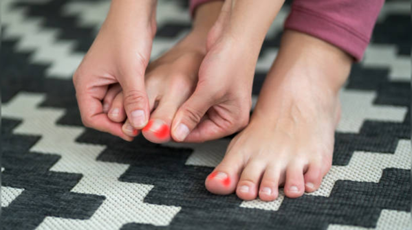 Hallux Limitus