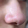 First, what exactly are blackheads?