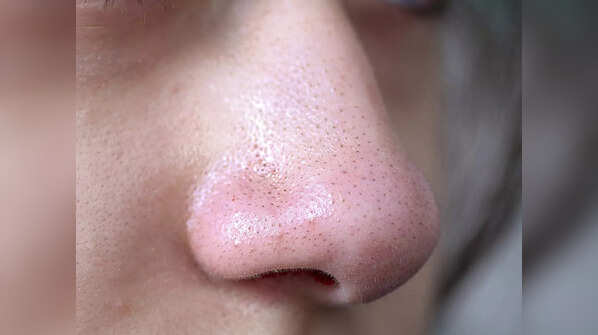 First, what exactly are blackheads?