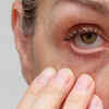 Dry eyes