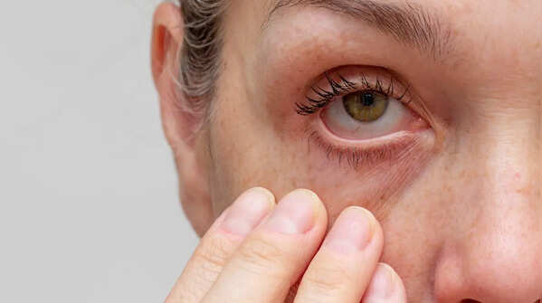 Dry eyes