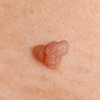 Skin changes you've been meaning to look at
