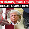 Article image for: Trump Health SHOCKER: ‘Hand Bruising, Leg Swelling’ Back In Focus Amid White House Clean Chit