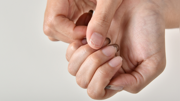 When nails lose their natural colour