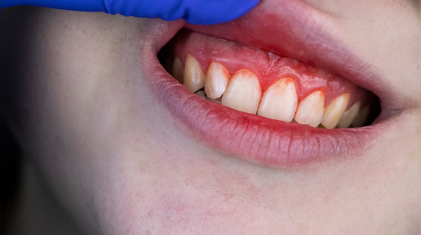 Small daily habits that keep gums healthy