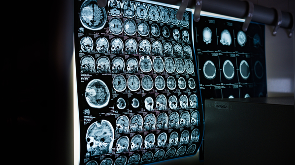Myth 4: Mobile phones cause brain tumours