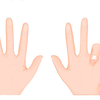 Viking disease: Scientists say this hand condition may be inherited ...
