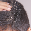 Article image for: 5 hair oils that may be making your dandruff worse