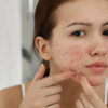 Article image for: Pigmentation, acne scars or ageing? 5 questions that can help identify the right treatment path