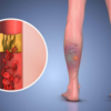 What is peripheral vascular disease or PVD?