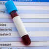 10 common blood tests and what they really reveal about your health ...
