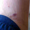 You bruise easily
