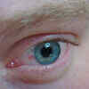 Your eyes are bloodshot