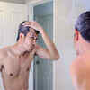 ​Male pattern baldness