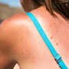 ​Sunburn