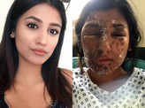 Aspiring Muslim model becomes victim of acid attack