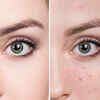 ​Fight acne