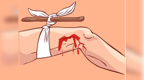 Applying tourniquet even if there is no arterial bleeding