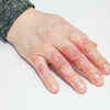 Straightaway applying ointment on burns