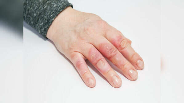 Straightaway applying ointment on burns