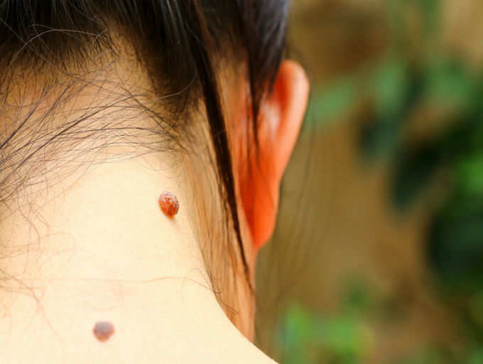 What Having Birthmark On These Parts Of Your Body Really Means The Times Of India