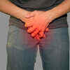 Peyronie’s Disease