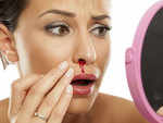 Top 10 home remedies for nosebleeds!