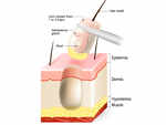 ​Preparation for the hair transplant