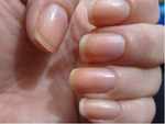 Why do nails turn yellow after using nail polishes?
