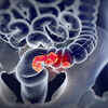 Colorectal cancer
