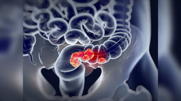 Colorectal cancer