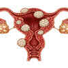 Uterine fibroids