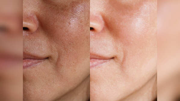 5 ways to get rid of open pores