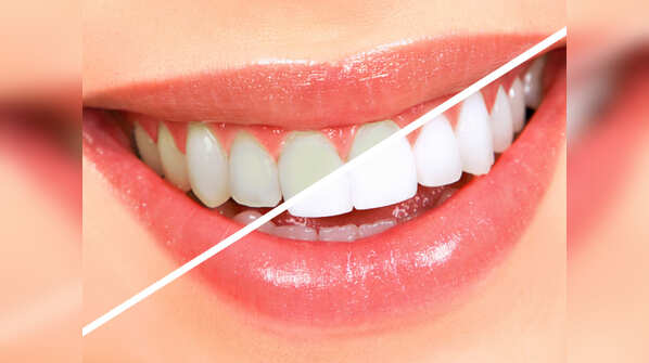 How to whiten your teeth at home