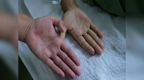 Anaemia