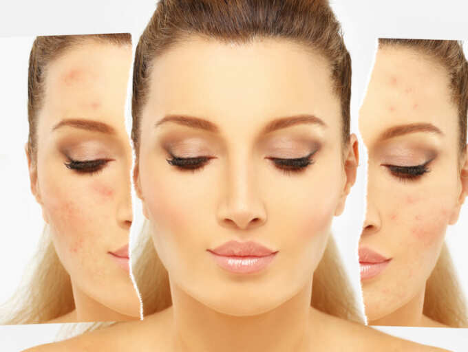 5 baking soda hacks for a beautiful skin