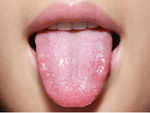 Whitish bumps on your tongue