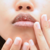 Dry skin/lips