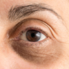 ​Eyebags