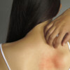 ​You develop rashes everywhere