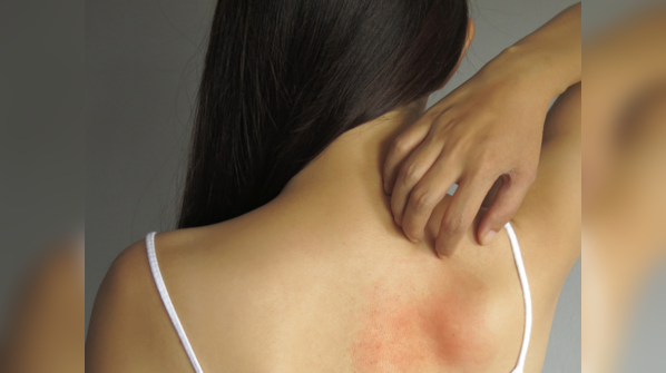 You develop rashes everywhere