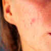 Calm the inflammation