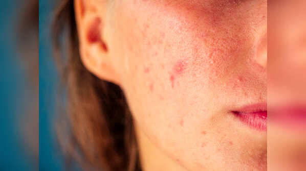 Calm the inflammation